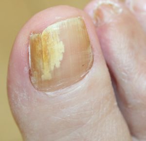 A fungal nail infection.
