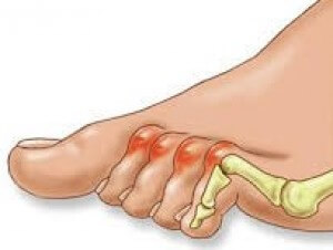 A medical diagram of Hammer Toes.