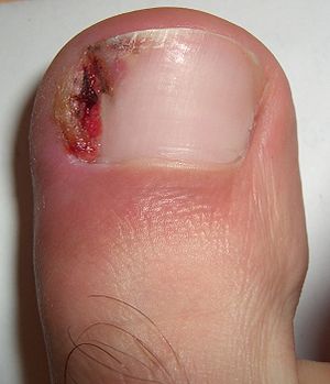 An ingrown toenail on the big toe.